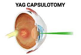 YAG Kapsulotomie