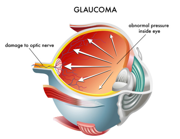 Glaukom-Vorsorge